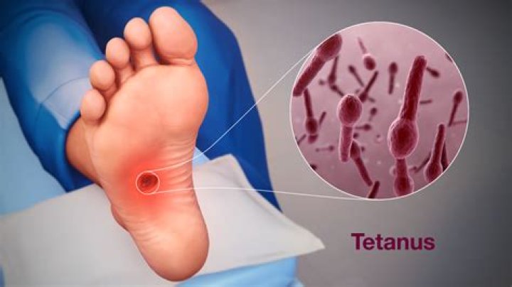How does tetanus look like?